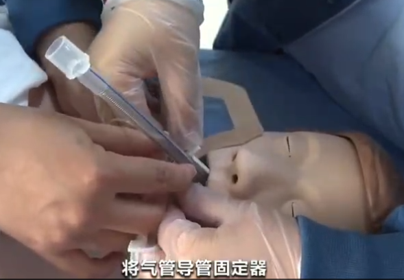 气管导管固定器